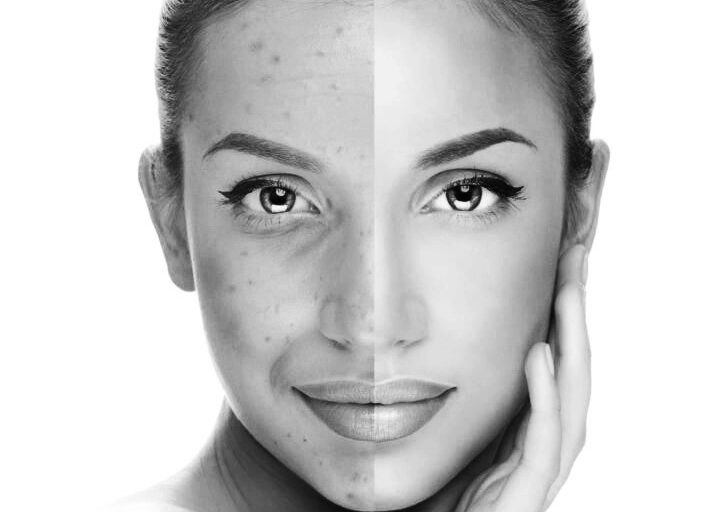 Cosmelan treatment at Med Clinic in Antwerp