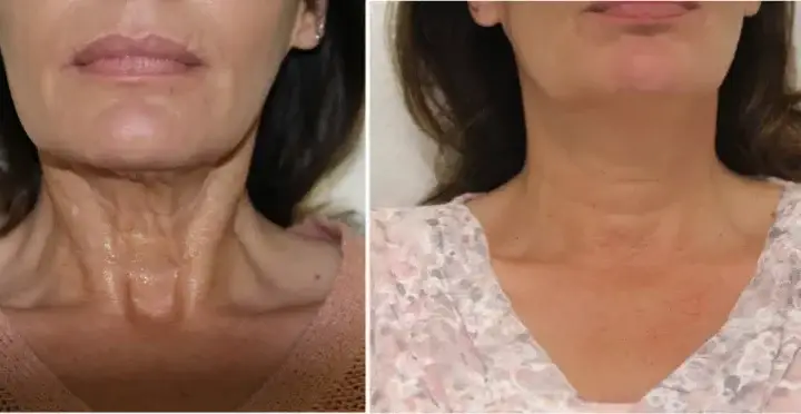 Hifu Antwerp 2 Before and after results of the HIFU treatment